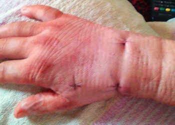 Oskarża szpital o zakażenie gronkowcem