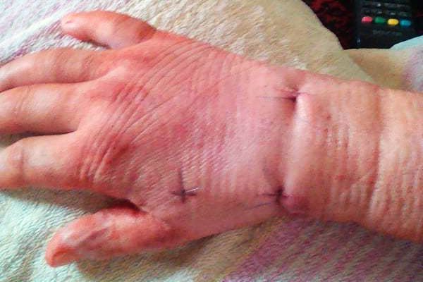 Oskarża szpital o zakażenie gronkowcem