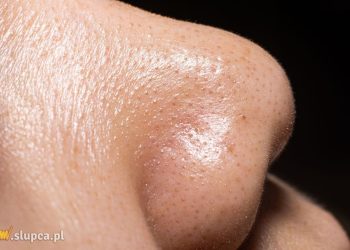 Czym są zaskórniki zamknięte i co je odróżnia od otwartych?