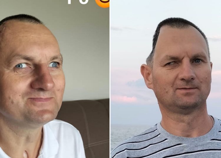 Przeszedł ważną operację. „Przyzwyczaja się do nowego wizerunku”