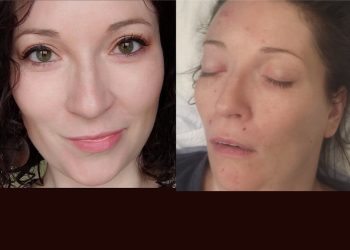 Karolina przeszła rozległy udar. Trwa zbiórka na leczenie