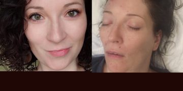 Karolina przeszła rozległy udar. Trwa zbiórka na leczenie