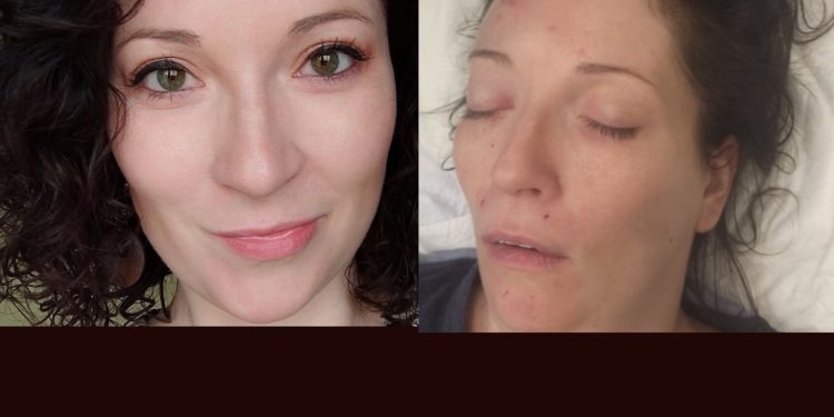 Karolina przeszła rozległy udar. Trwa zbiórka na leczenie