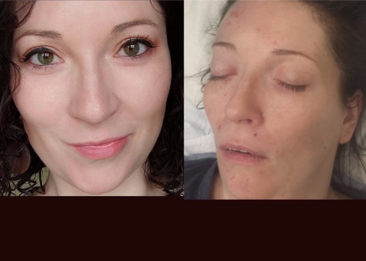 Karolina przeszła rozległy udar. Trwa zbiórka na leczenie