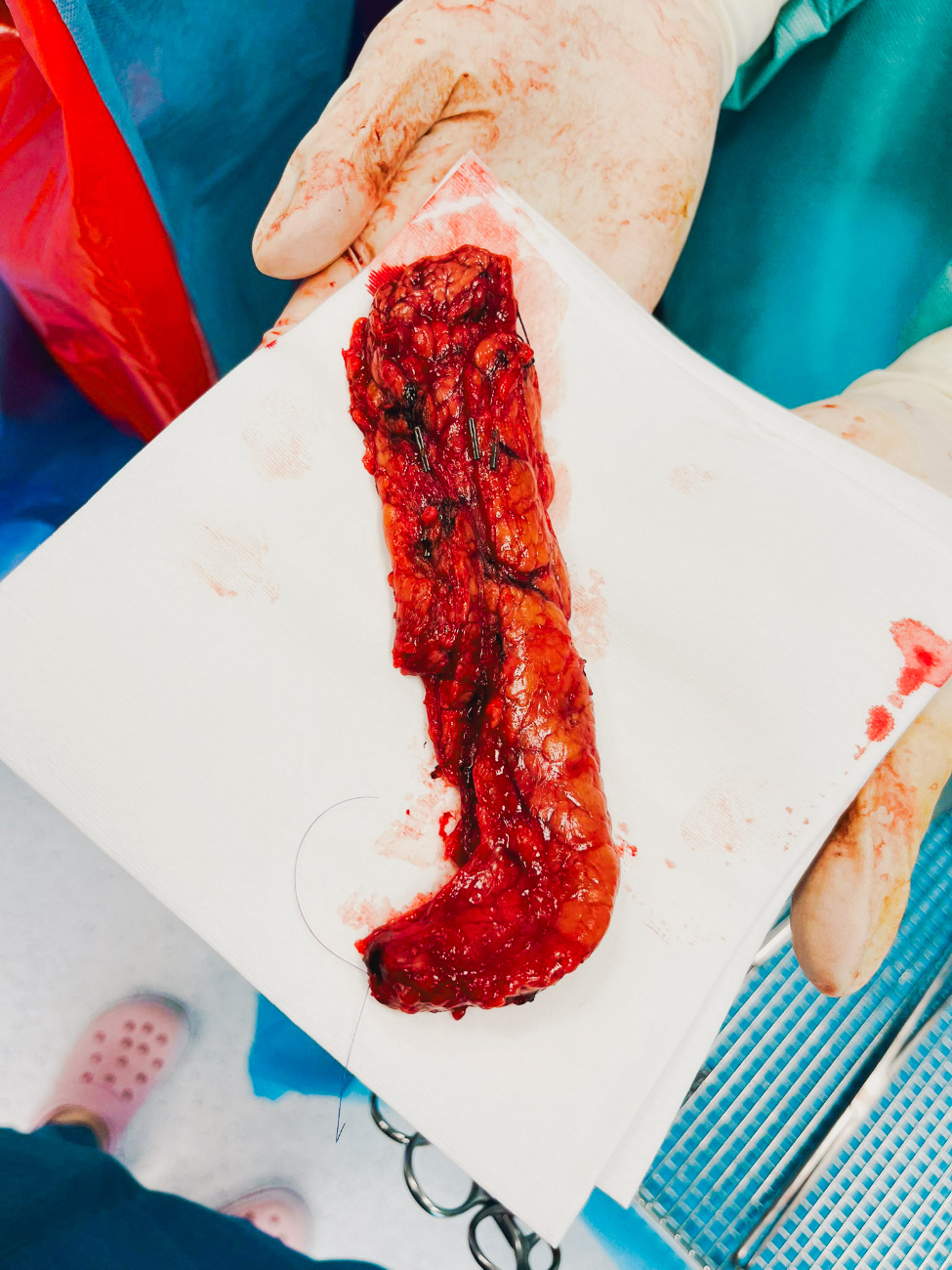 Kolejna udana operacja trzustki. „Dla naszych Chirurgów to codzienność”