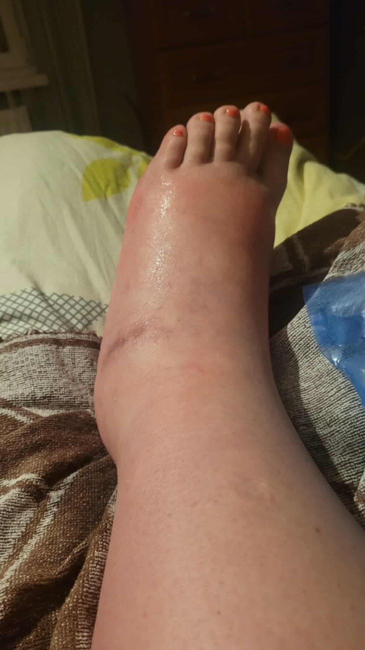 „Chodziłam od lekarza do lekarza”. Teraz Monika ma szansę na życie bez bólu